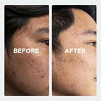 SkinLuv Clinify Anti Acne Serum with Salicylic Acid | Grocsy