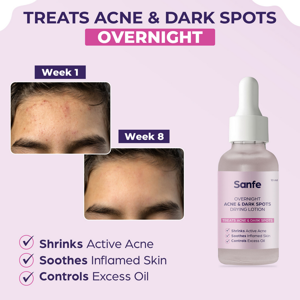 Sanfe Overnight Acne & Dark Spots Drying Lotion | Grocsy