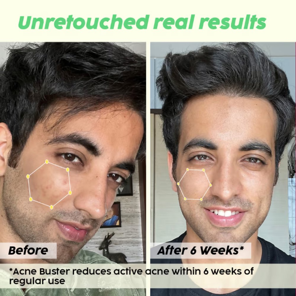 PLIX The Plant Fix 2% Salicylic Acid Active Acne Control Serum & Acne Buster Moisturizer Combo | Grocsy