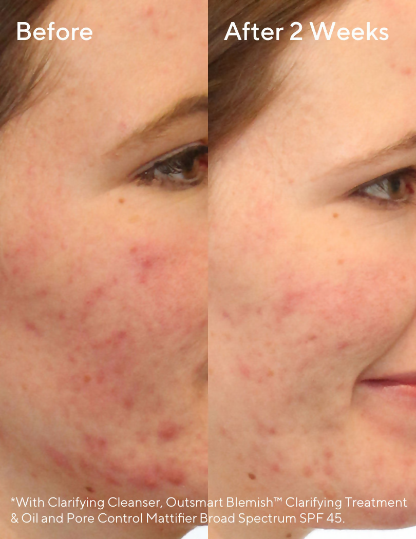 Murad Blemish Control Clarifying Cleanser | Grocsy