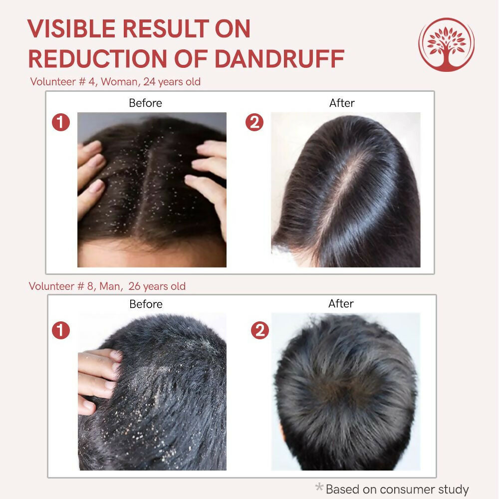 Ivory Natural Dandruff Hair Serum For Nourishing Dry Scalp | Grocsy