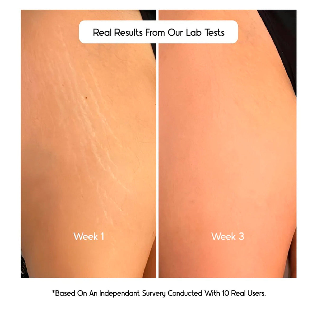 Cos-IQ Stretch Marks Removal Roll-On Serum with Striover | Grocsy