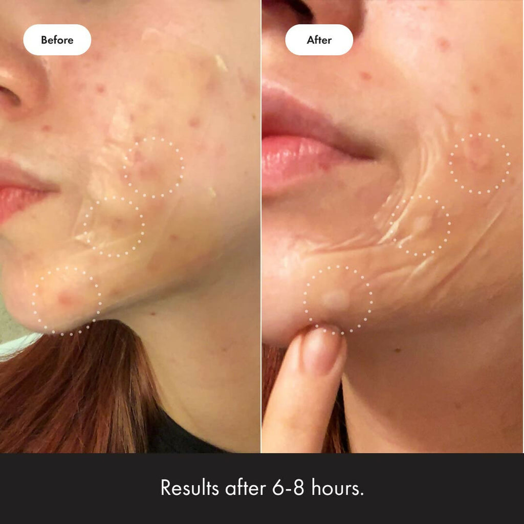 Mighty Patch Surface - Hydrocolloid Large Acne Pimple Patches Spot Treatment for Body and Larger Breakouts on Cheek, Forehead, Chin | Grocsy