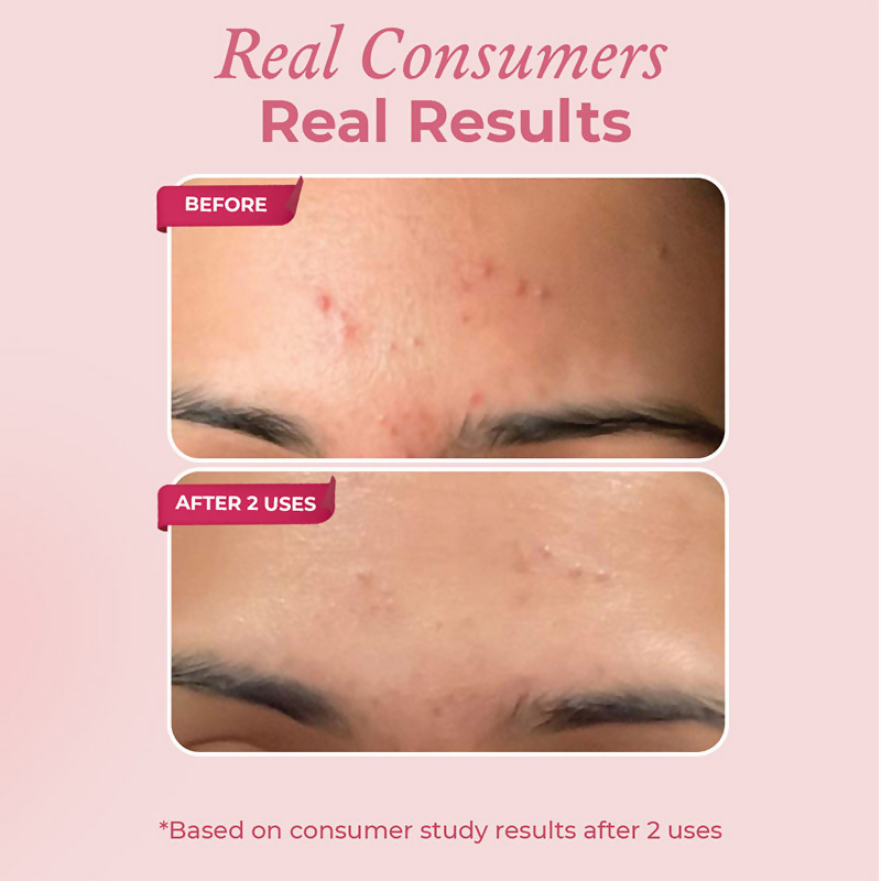 The Pink Foundry Acne Spot Corrector With Salicylic Acid For Active Acne Blackheads & Whiteheads | Grocsy