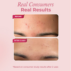 The Pink Foundry Acne Spot Corrector With Salicylic Acid For Active Acne Blackheads & Whiteheads | Grocsy