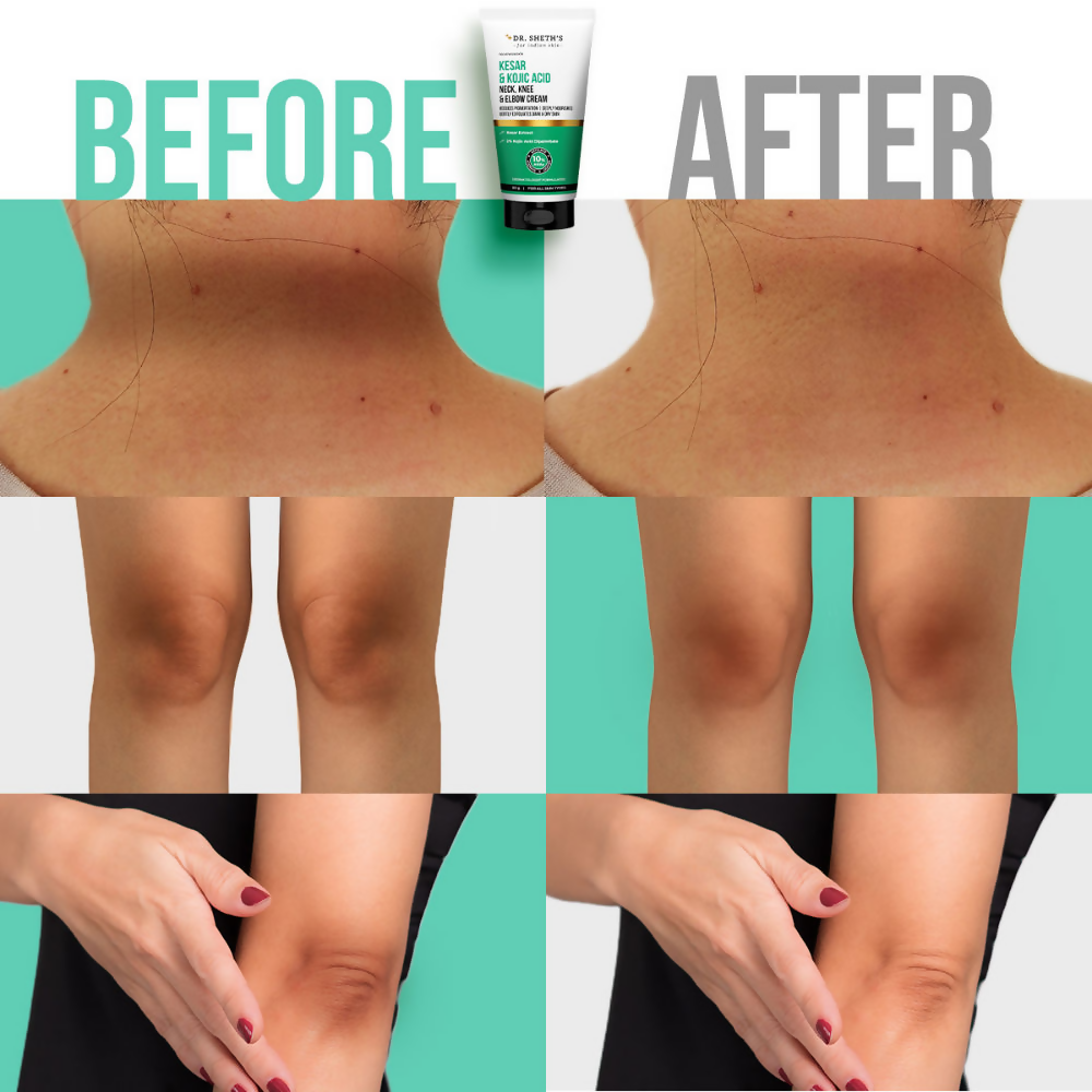 Dr. Sheth's Kesar & Kojic Acid Neck Knee & Elbow Cream | Grocsy