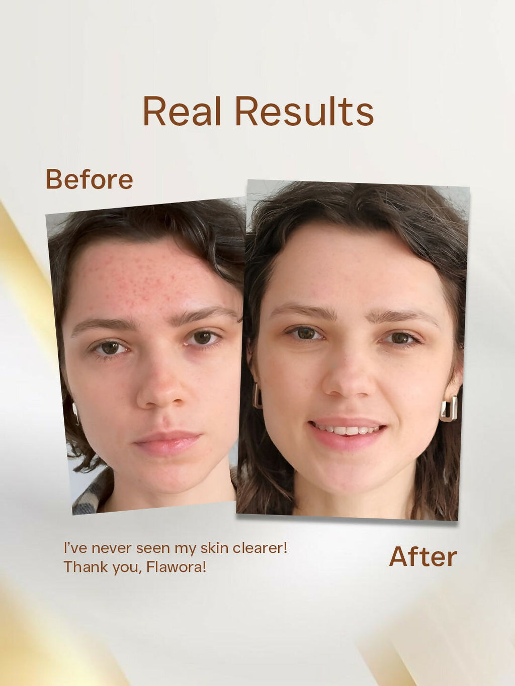 Flawora Anti Acne Serum | Grocsy