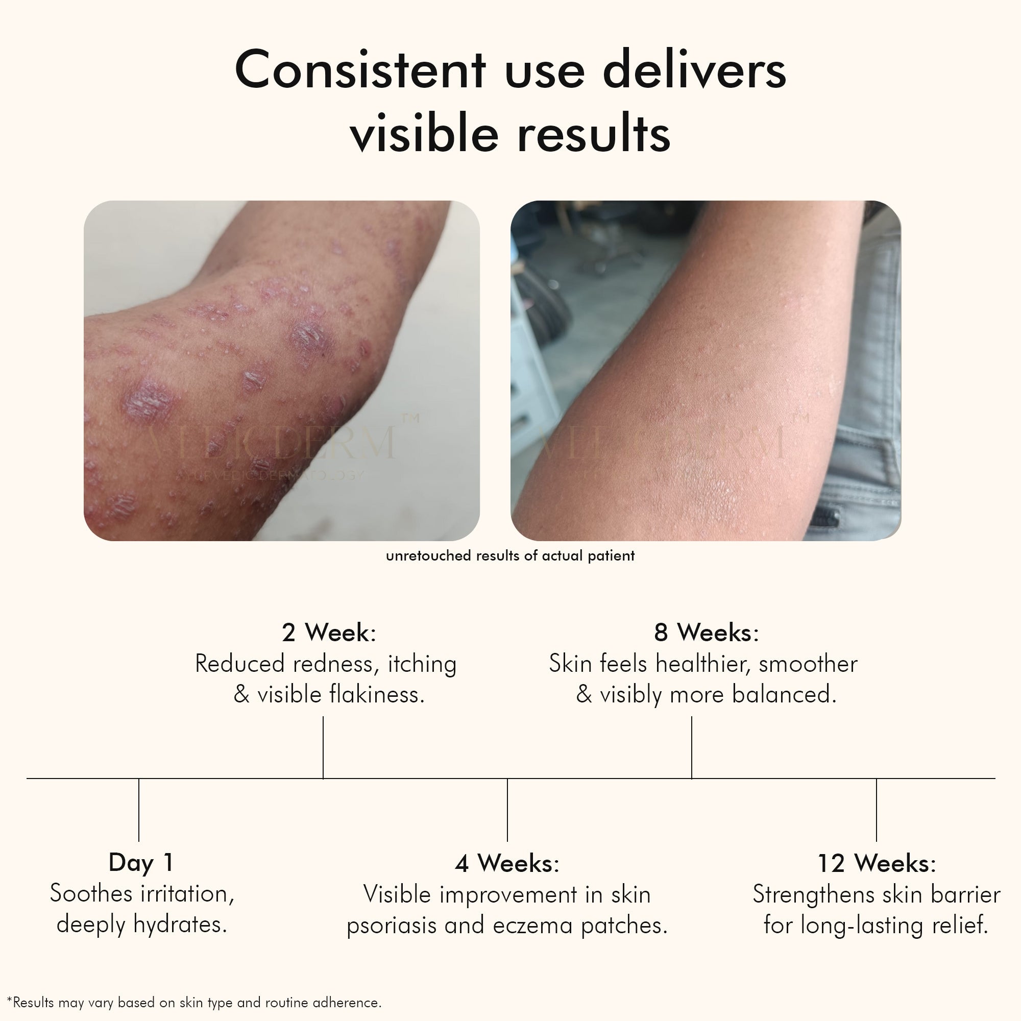 Vedicderm Psoriasis Cream with 2% Bakuchi Extract | Grocsy