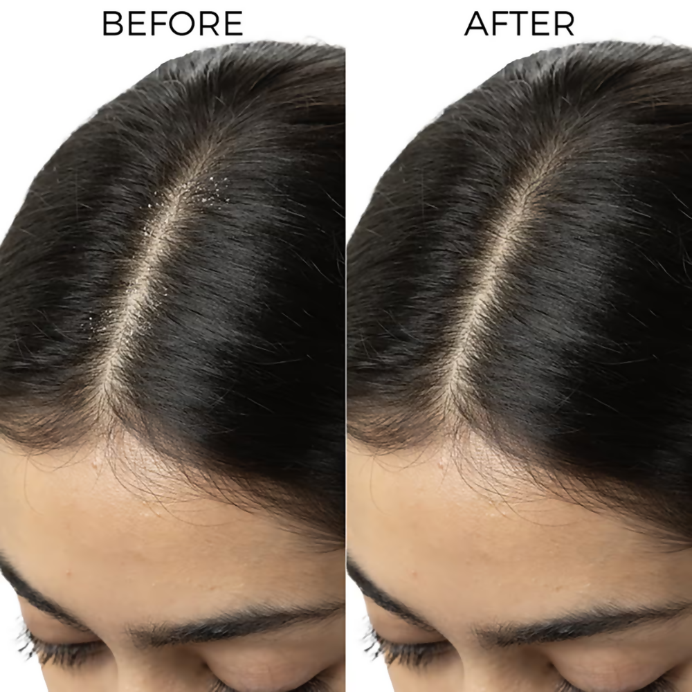 Brillare Tea Tree & Salicylic Oil Shots For Dandruff Control | Grocsy
