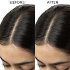 Brillare Tea Tree & Salicylic Oil Shots For Dandruff Control | Grocsy