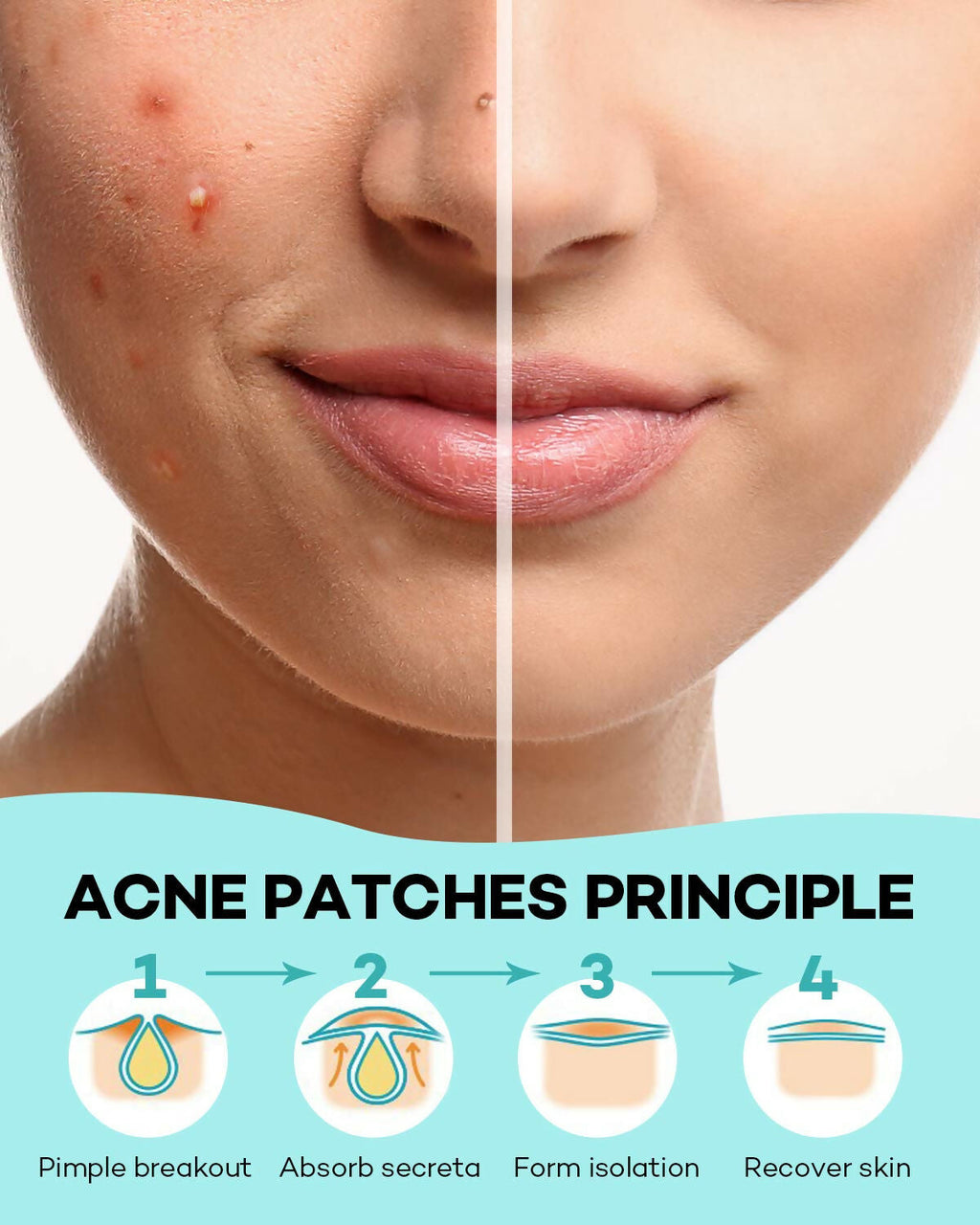 TKTK Acne Patch Pimple Patch - Acne Absorbing Cover Patch, Hydrocolloid Invisible Acne Patches For Face Zit Patch Acne Dots Tea Tree, Calendula Oil | Grocsy