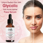 Globus Remedies Glycolic & 1% Salicylic Acid Anti Acne Face Serum | Grocsy