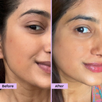 PLIX The Plant Fix Jamun Active Acne Regime With Cleanser, Toner & Moisturizer For Women & Men | Grocsy