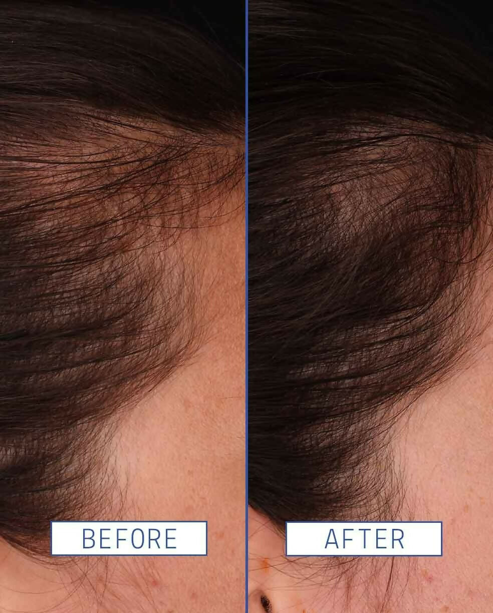 Aavrani Hair Density Boosting Treatment (Serum) | Grocsy