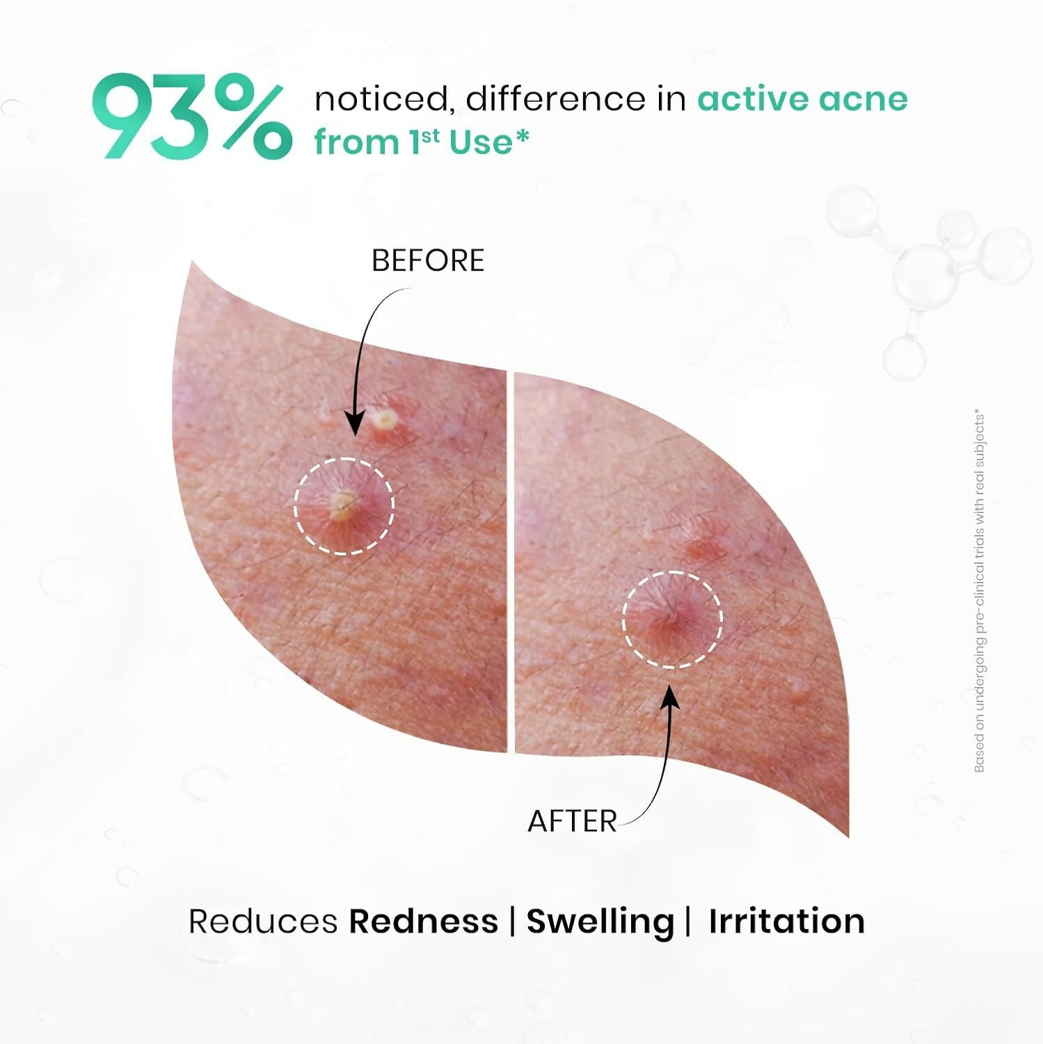 SkinInspired AcNil3 Rapid Spot Corrector | Grocsy