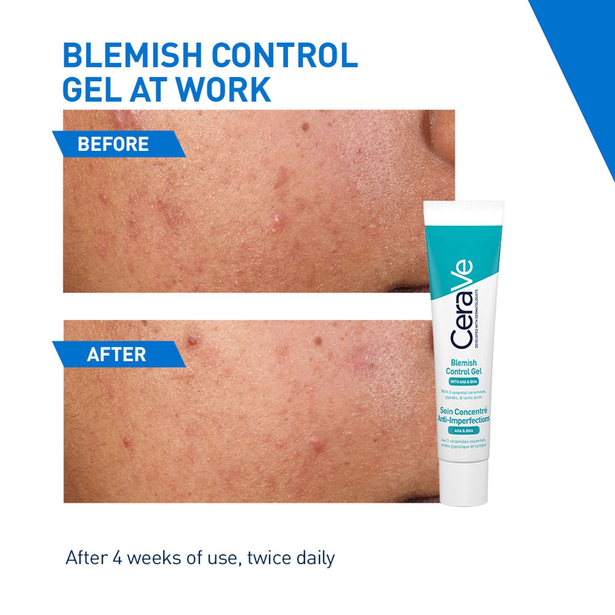 CeraVe Blemish Control Gel with 2% Salicylic Acid, AHA & Niacinamide for Acne Spot Treatment | Grocsy