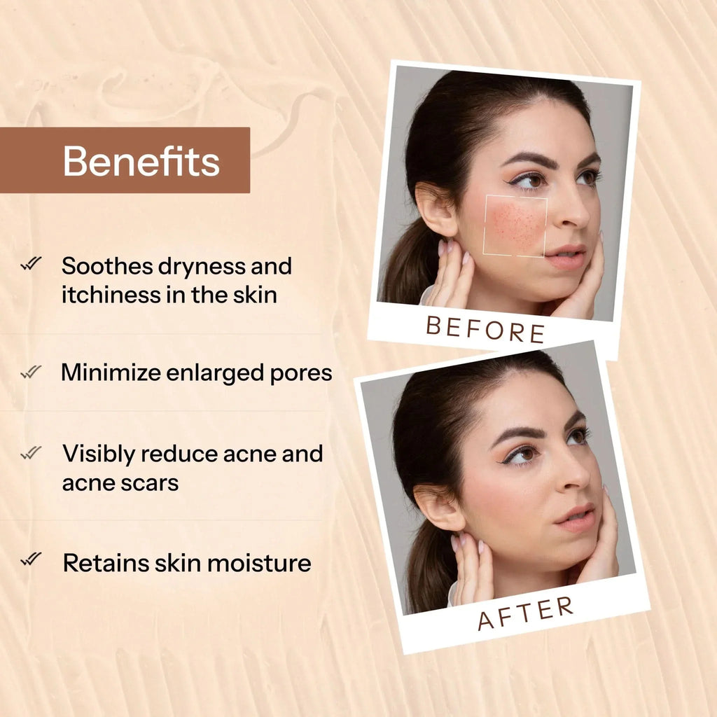 Glopetra Acne Scars & Pits Removal Gel | Grocsy