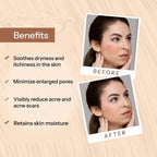 Glopetra Acne Scars & Pits Removal Gel | Grocsy