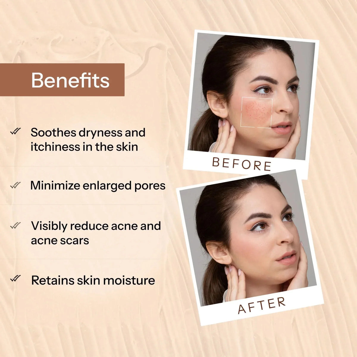 Glopetra Acne Scars & Pits Removal Gel | Grocsy