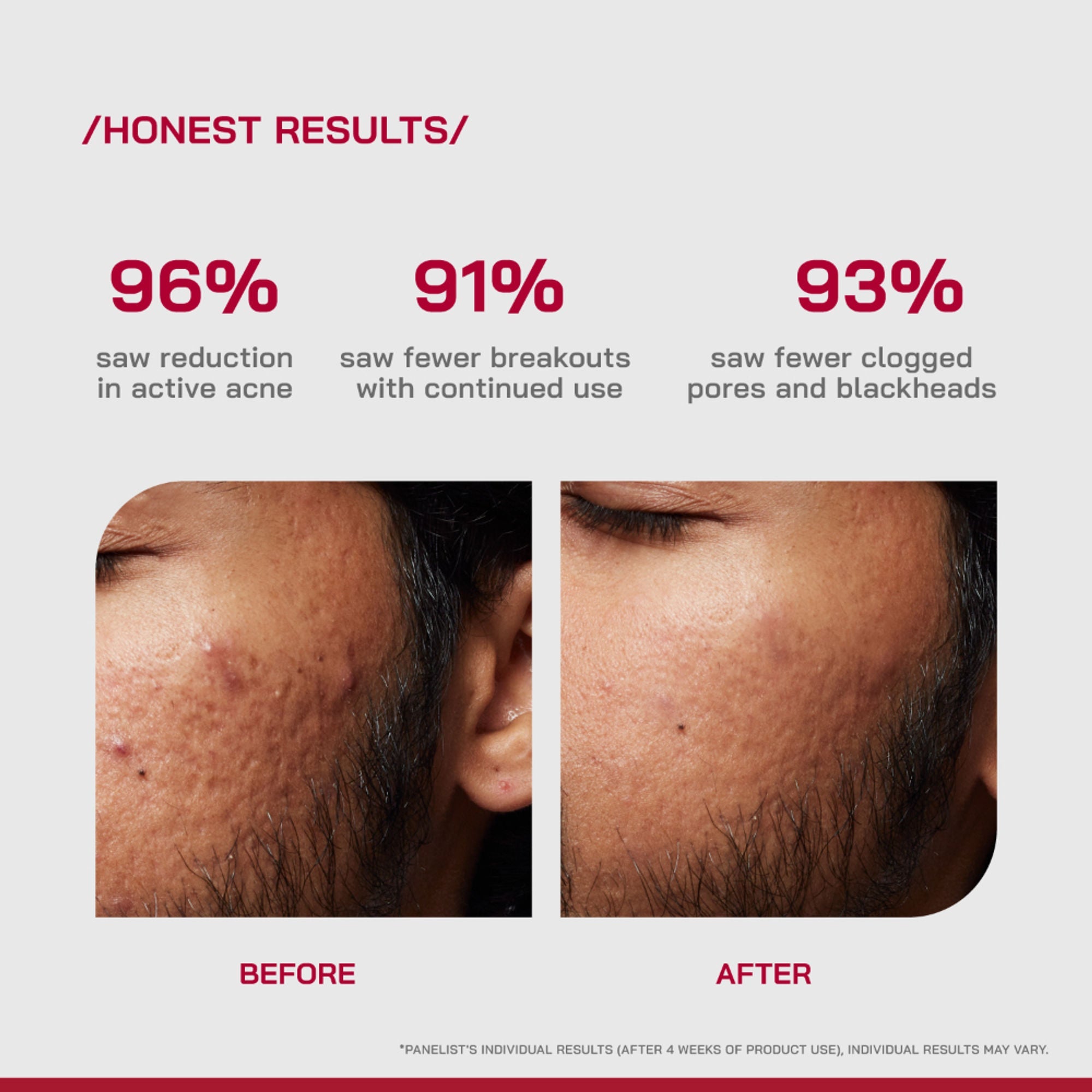 Proven Honest Derma (PHD) 2% Salicylic Acid Anti-Acne Serum | Grocsy