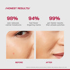 Proven Honest Derma (PHD) Salicylic Acid Acne Spot Gel | Grocsy