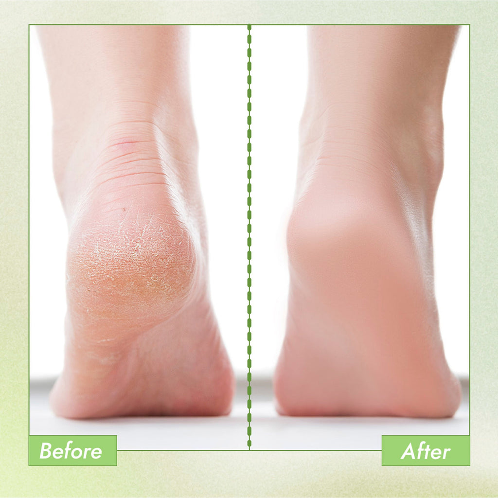 Nykaa Skin Happy Heels 20%Urea, 2%Lactic Acid Foot Cream-Dry & Cracked Feet - Tea Tree & Aloe Vera | Grocsy