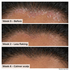 VedicDerm Plasma Bamboo Charcoal Shampoo for Psoriasis & Sensitive Scalp | Grocsy