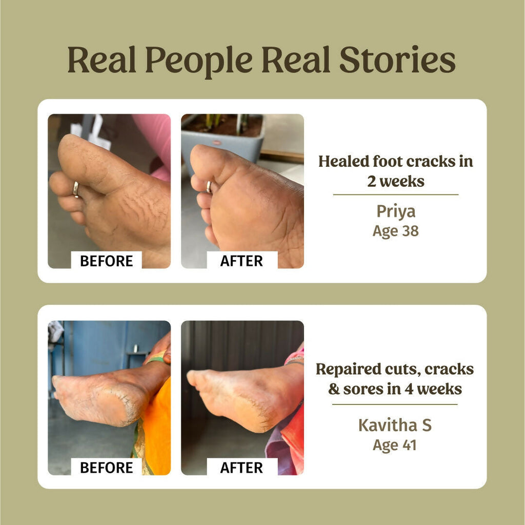 Vilvah Store Foot Cream (Treats Cracked Heels) | Grocsy