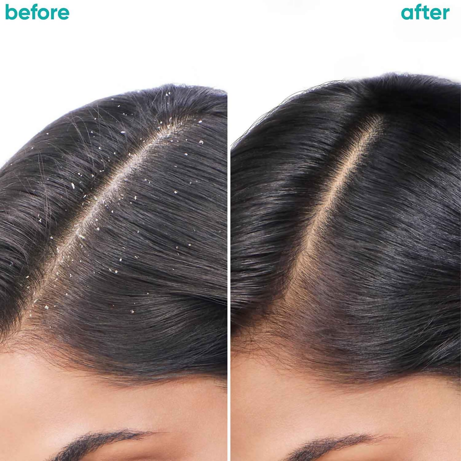 Matrix Biolage Scalppure Anti-Dandruff Shampoo and Conditioner Combo | Grocsy