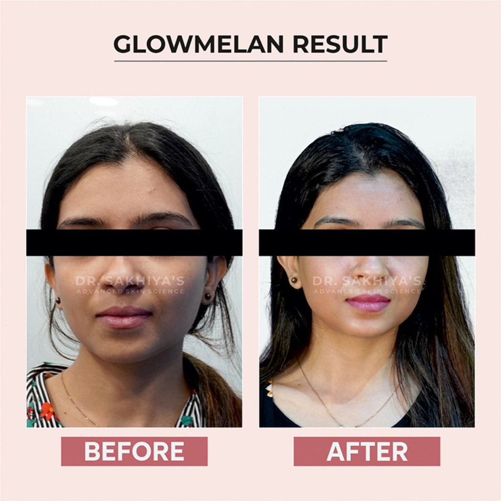 Dr.Sakhiya Glowmelan Brightening & Depigmentation Gel Cream | Grocsy