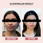 Dr.Sakhiya Glowmelan Brightening & Depigmentation Gel Cream | Grocsy