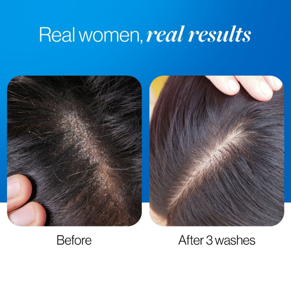 BeBodywise ZPTO Anti Dandruff Shampoo - Reduces Dandruff, Flaking & Deeply Hydrates Scalp | Grocsy