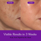 Bake Kojic Acid + Turmeric NightPeel Rx Mask | Grocsy
