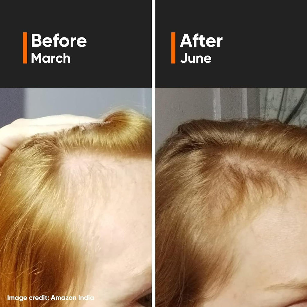 Minimalist Hair Growth Actives 18% Hair Serum | Grocsy