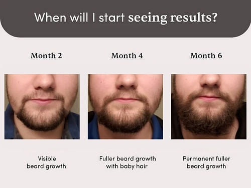 Man Matters Beardmax Growth Serum, Minoxidil 5% | Grocsy