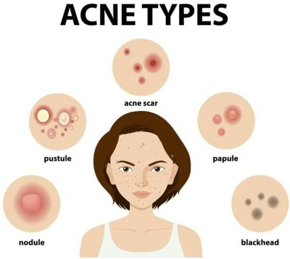 Ipca Acne UV Gel SPF 50 | Grocsy