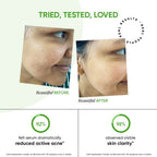Dot & Key 2% Salicylic Cica Anti Acne Face Serum For Irritation & Unclogs Pores | Grocsy