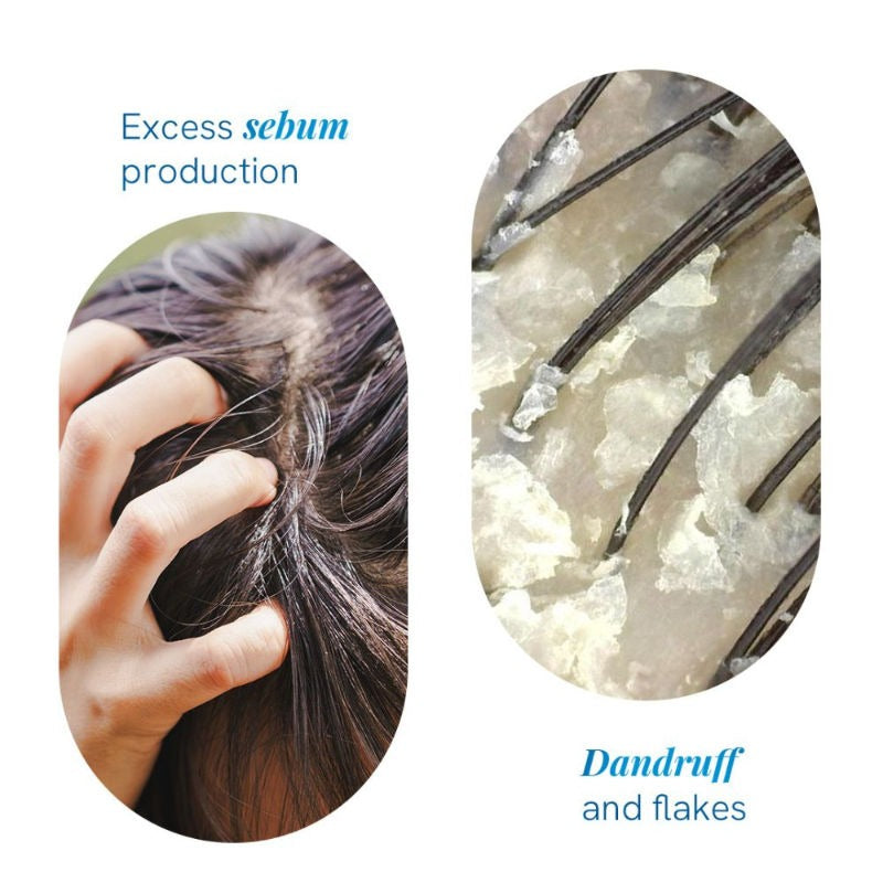 BeBodywise 1% Ketoconazole Dandruff Shampoo For Smooth & Frizz Free Hair | Grocsy