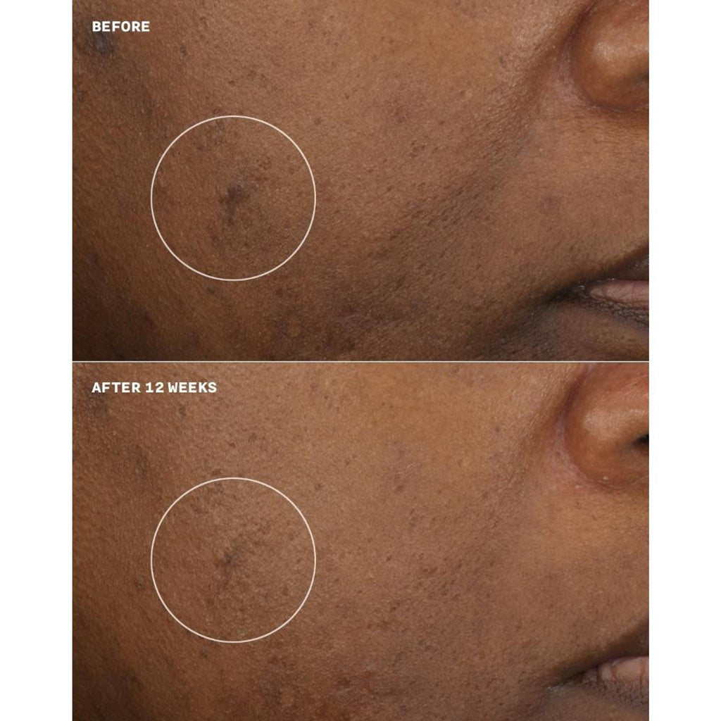 Clinique Even Better Clinical Brightening Moisturizer | Grocsy
