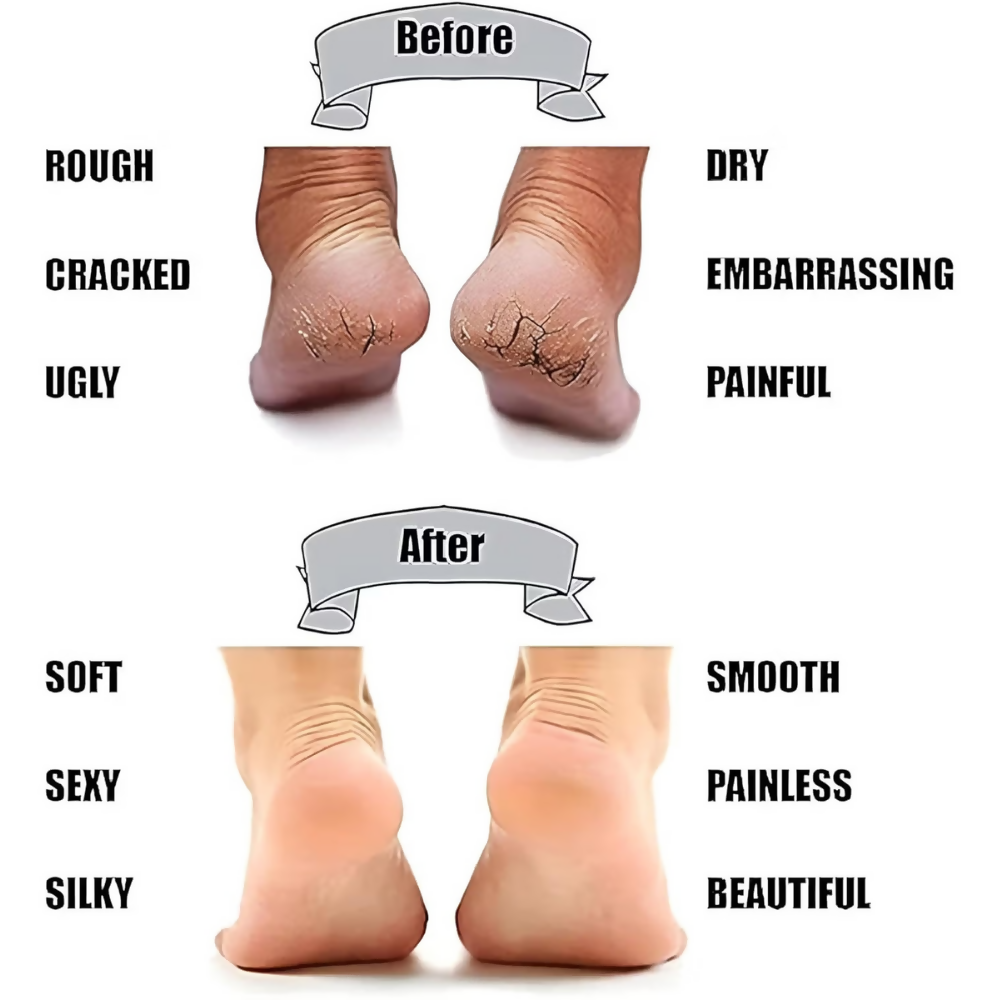 Bronson Professional Smiling Foot Anti Crack Silicone Socks | Grocsy