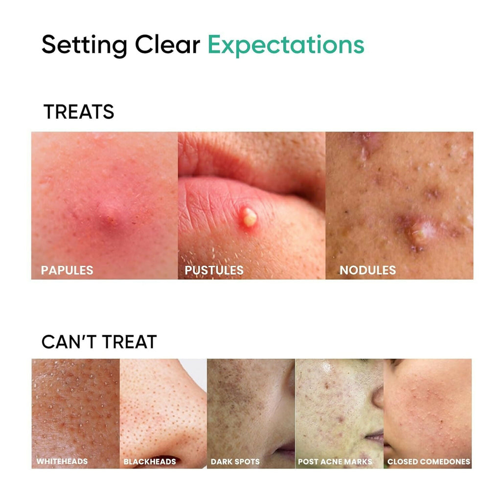 SkinInspired AcNil3 Rapid Spot Corrector | Grocsy