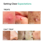 SkinInspired AcNil3 Rapid Spot Corrector | Grocsy