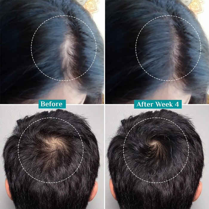 Pilgrim 3% Redensyl, 4% Anagain & 5% Capilia Stem Cell Complex Advanced Hair Growth Serum Roll-On | Grocsy