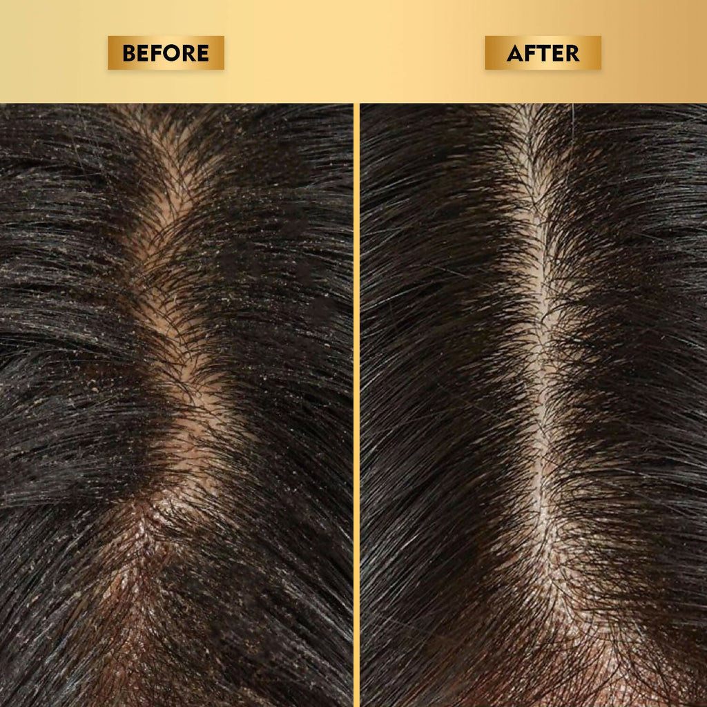 The Skin Story Anti-Dandruff Hair Scalp Serum | Grocsy