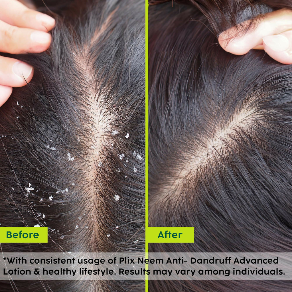 PLIX The Plant Fix Neem Anti-Dandruff Advanced Lotion Reduce Dandruff, Itching & Irritation | Grocsy