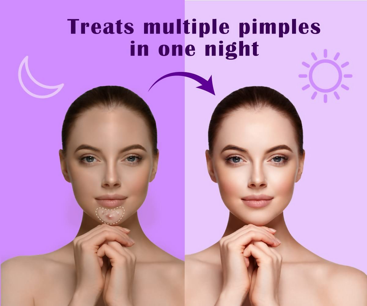 Urban Yog Acne Curvy Pimple Patch - Invisible Facial Stickers cover | Grocsy