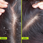 PLIX The Plant Fix Neem Anti-Dandruff Advanced Hair Serum For Reduce Dandruff & Inflammation | Grocsy