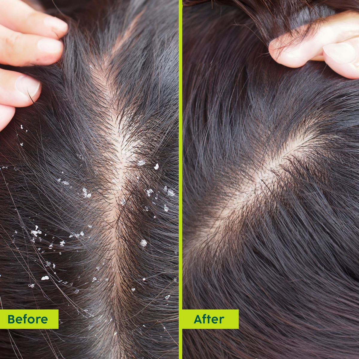 PLIX The Plant Fix Neem Anti-Dandruff Advanced Hair Serum For Reduce Dandruff & Inflammation | Grocsy