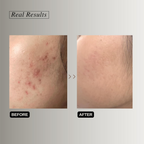 The Formularx Renaissance Gentle Retinol Complex Serum With Niacinamide & Bakuchiol | Grocsy
