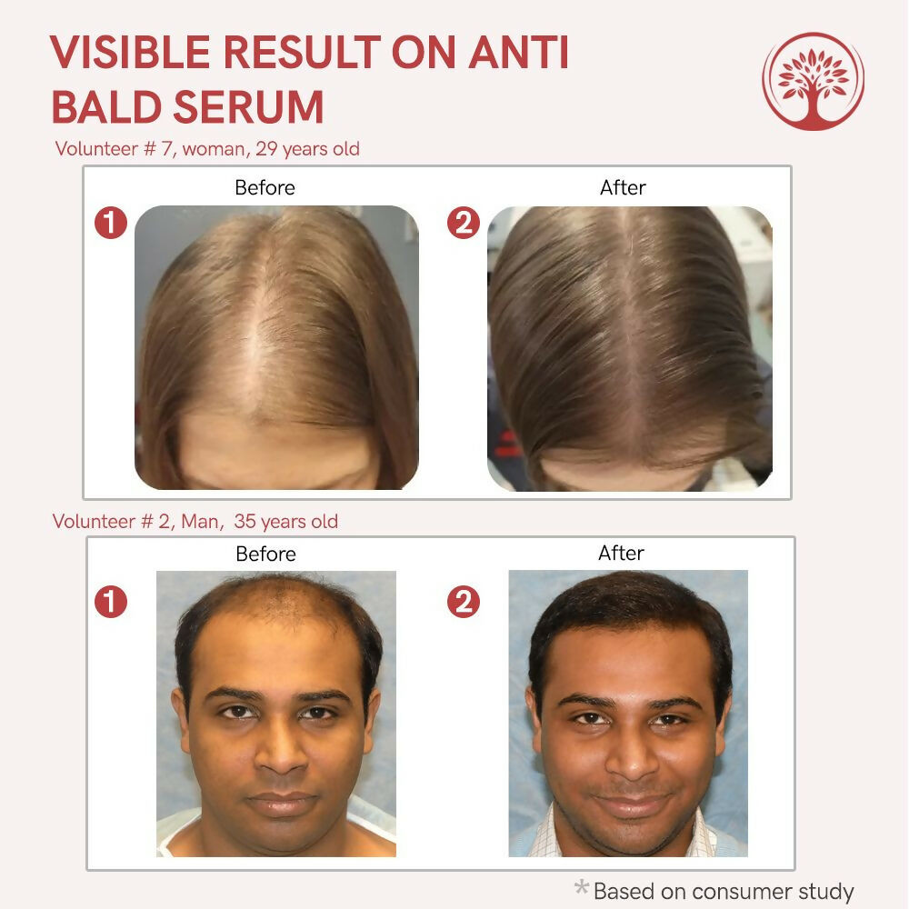 Ivory Natural Bald Serum For Baldness, Hair Thinning And Hair Fall | Grocsy